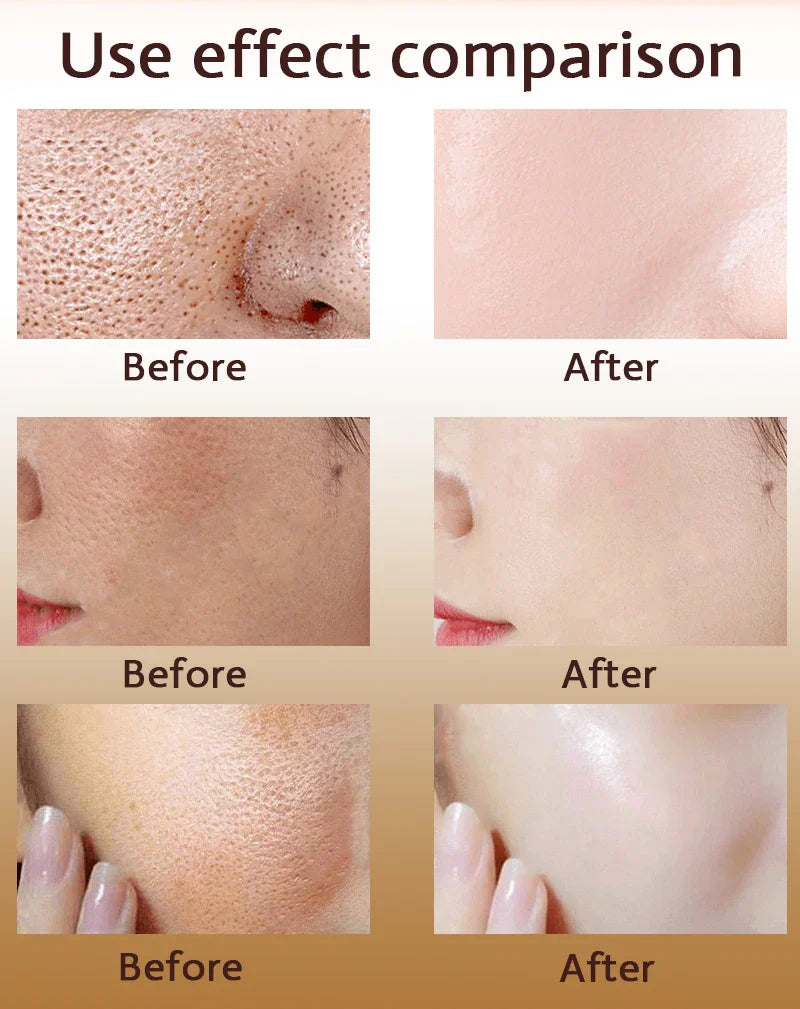 Acne Treatment Anti Aging Serum.