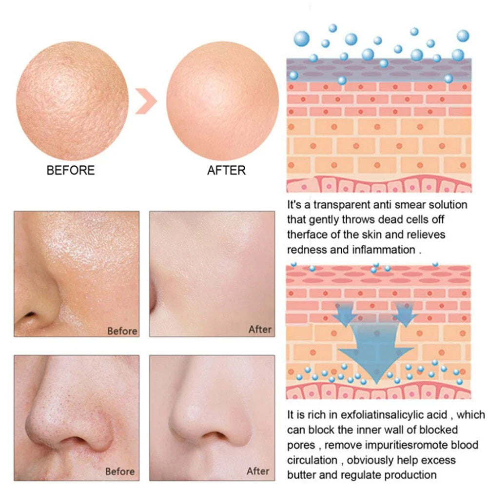 Acne Treatment Anti Aging Serum.