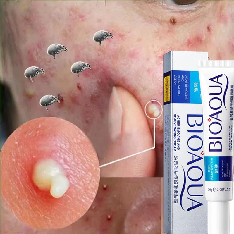 Herbal Acne Removal Face Cream.