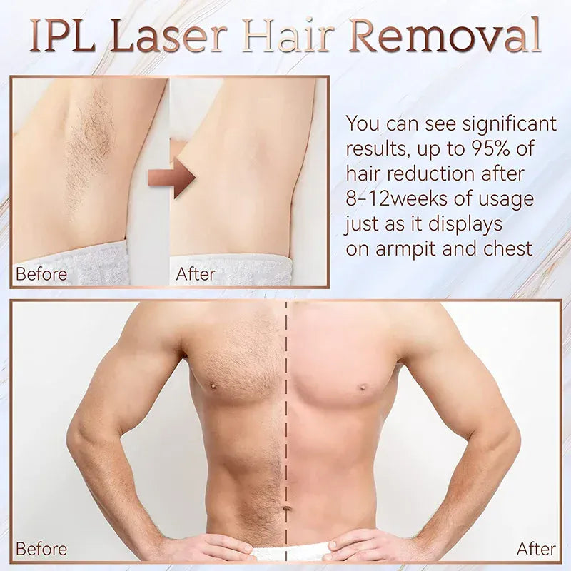 Painless Electric Epilator Laser Hair Removal.