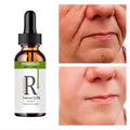 Retinol Anti Wrinkle Dark Spot Removal.